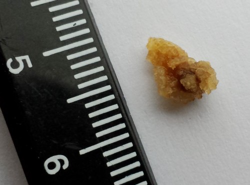 kidney stone